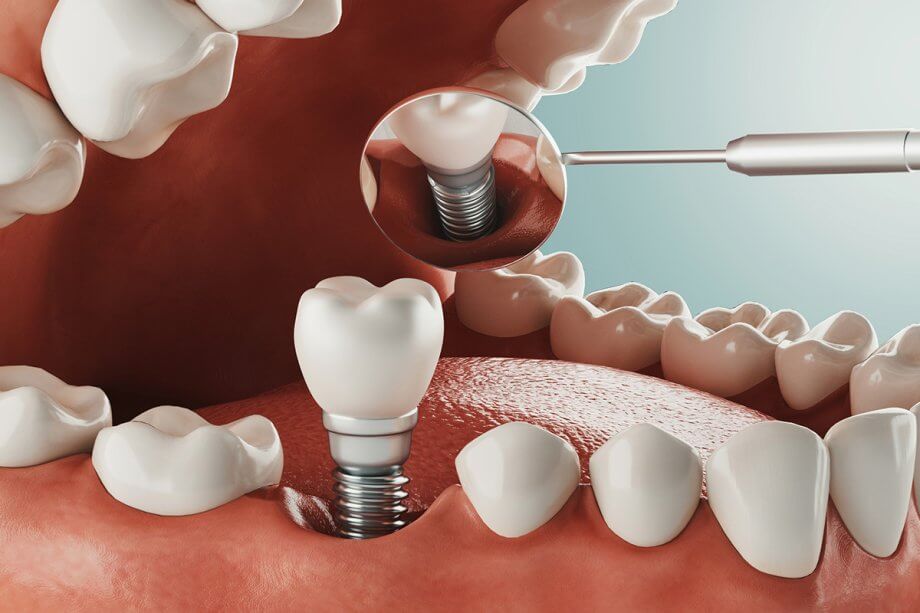 Can Dental Implants Be Done