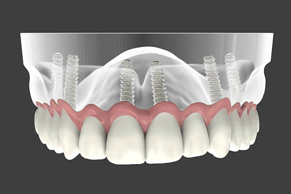 Dental Implant Supported Dentures in Bardonia