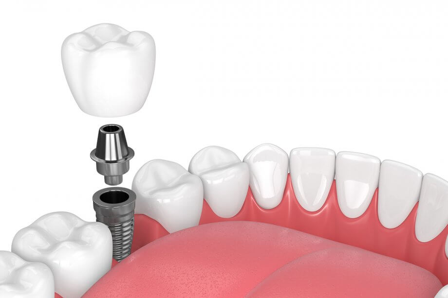 Am I A Candidate for Dental Implants?