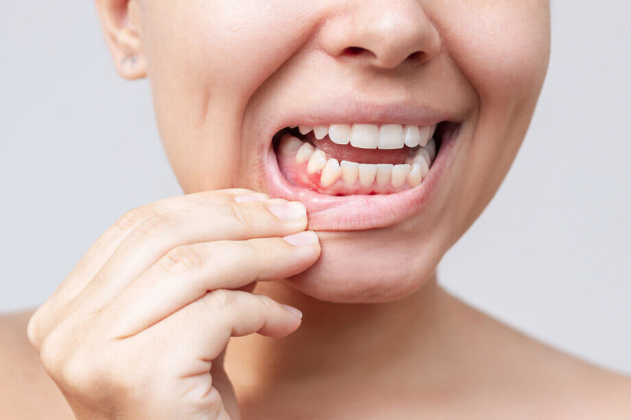 Can Scaling and Root Planing Reverse Early Gum Disease?