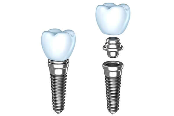 Single Dental Implants in Bardonia