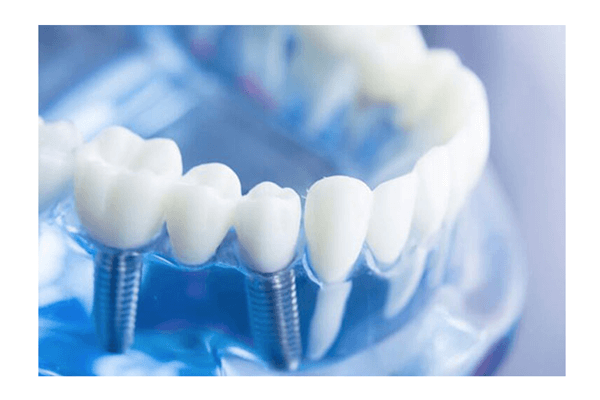 Dental Implants in Bardonia, NY