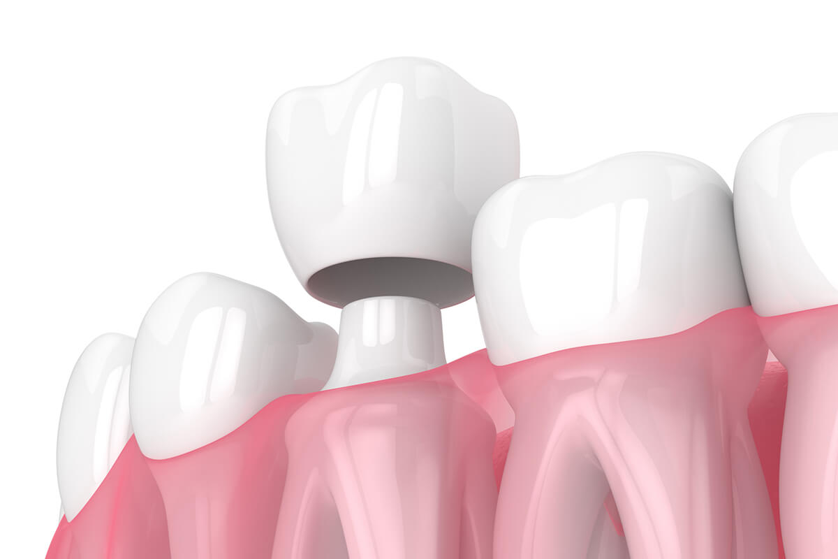 How Lengthy After Crown Lengthening Can I Get A Crown? DentalHealth