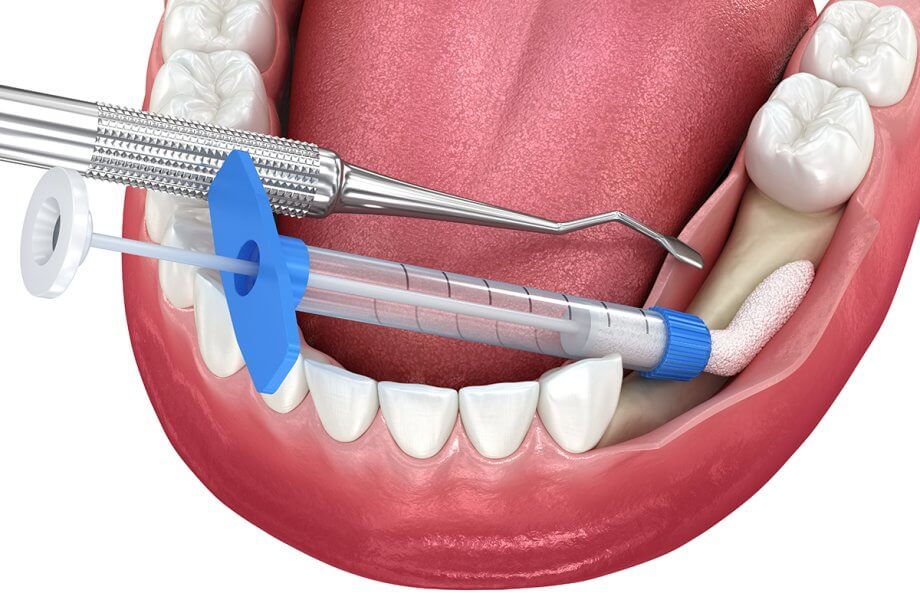 How Long Does It Take to Heal from Dental Bone Grafting?