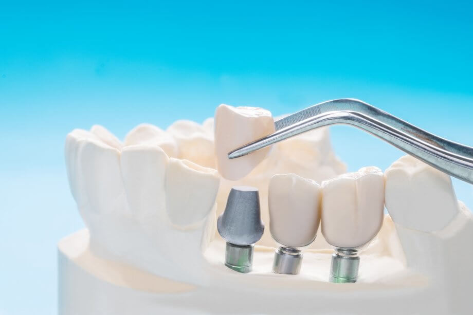 Close-Up of Dental Implant and Prosthodontic