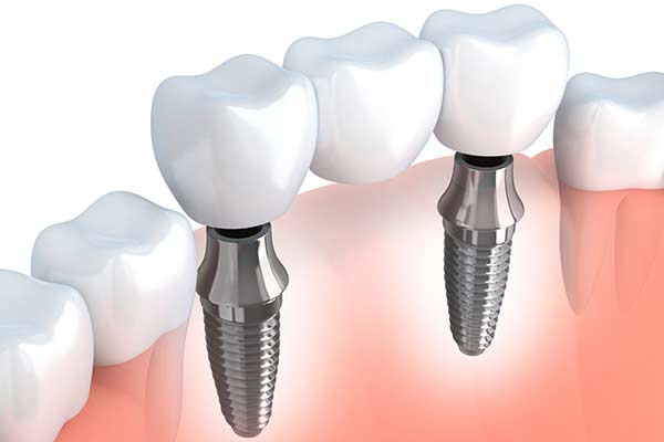 Dental Implant Supported Bridges in Bardonia