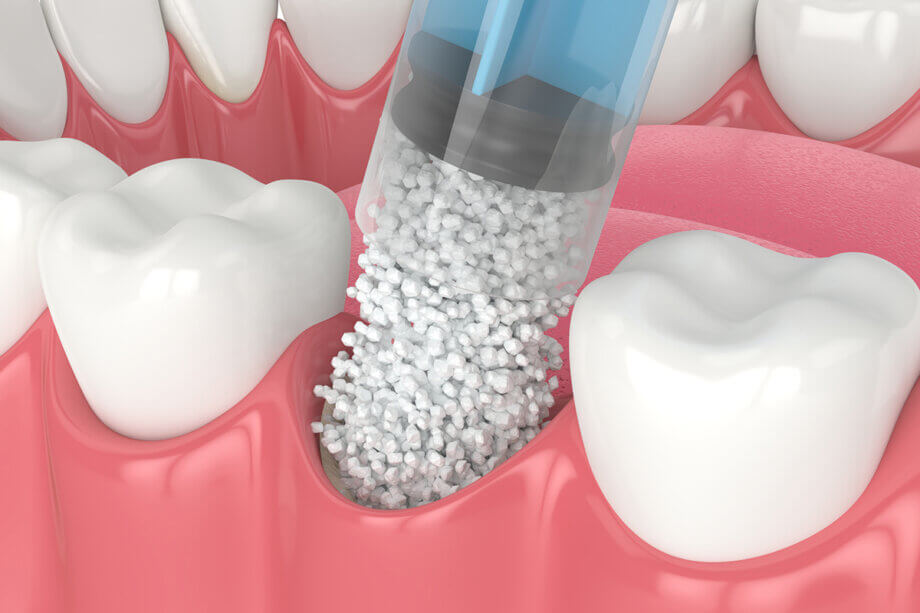 Ridge Preservation vs Bone Grafting: What’s the Difference?