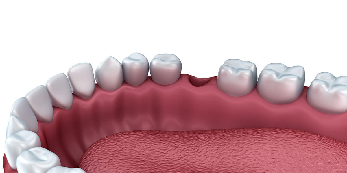 Smiling Patient Ridge Preservation