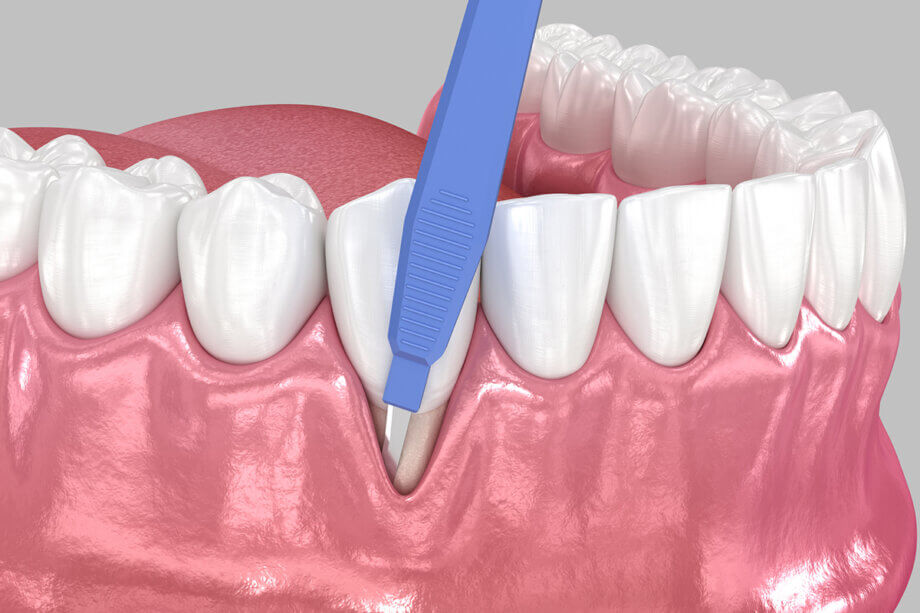 Types of Gum Grafts: Which Option Is Best for You?