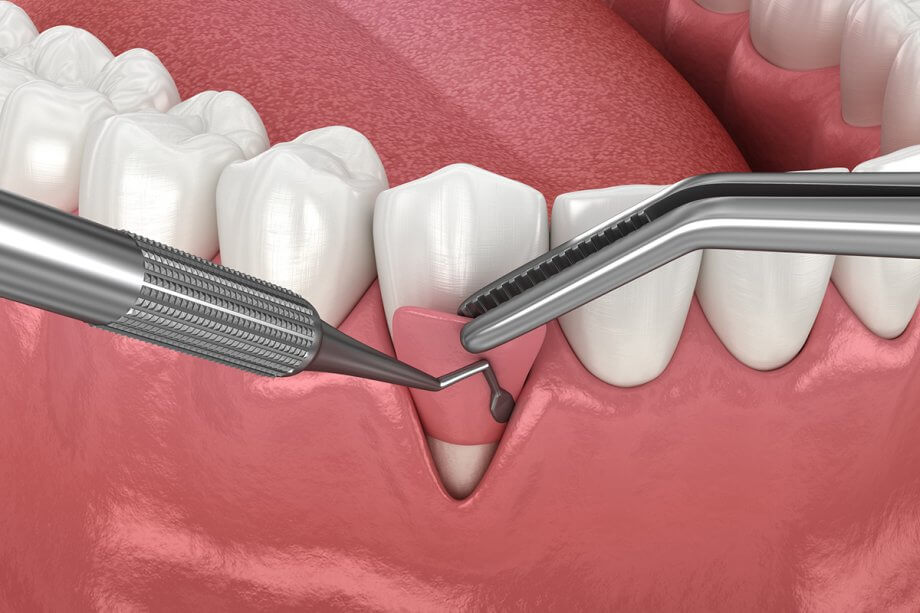 What to Expect After Gum Grafting: Tips for a Smooth Recovery